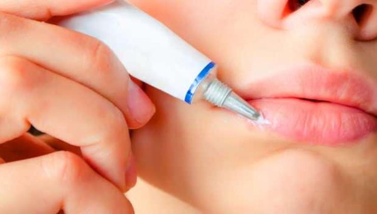 Dudakta uçuk neden çıkar, nasıl geçer? Stresten dudak uçuklaması…