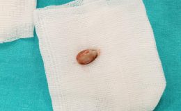 Doktorları şaşkına çeviren vaka: Nefes borusundan 3 yıl sonra çıkarıldı…